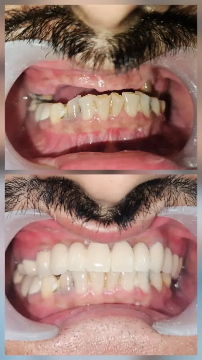Full Mouth Rehabilitation — before and after