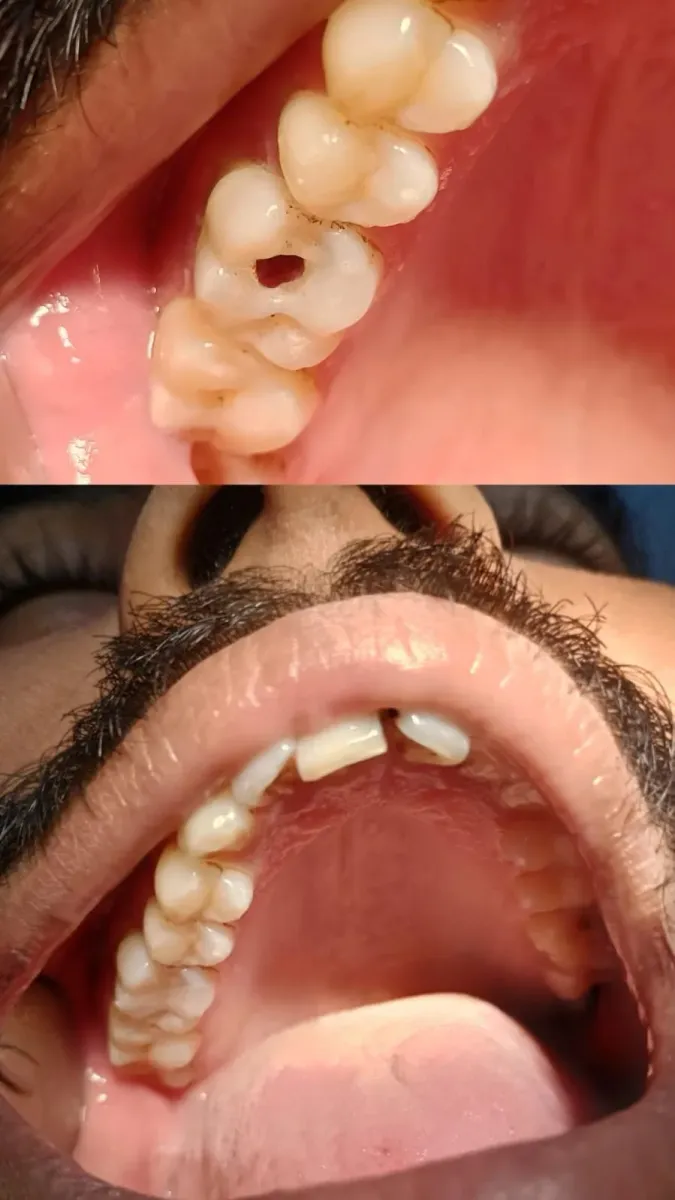 Filling & Restoration — before and after