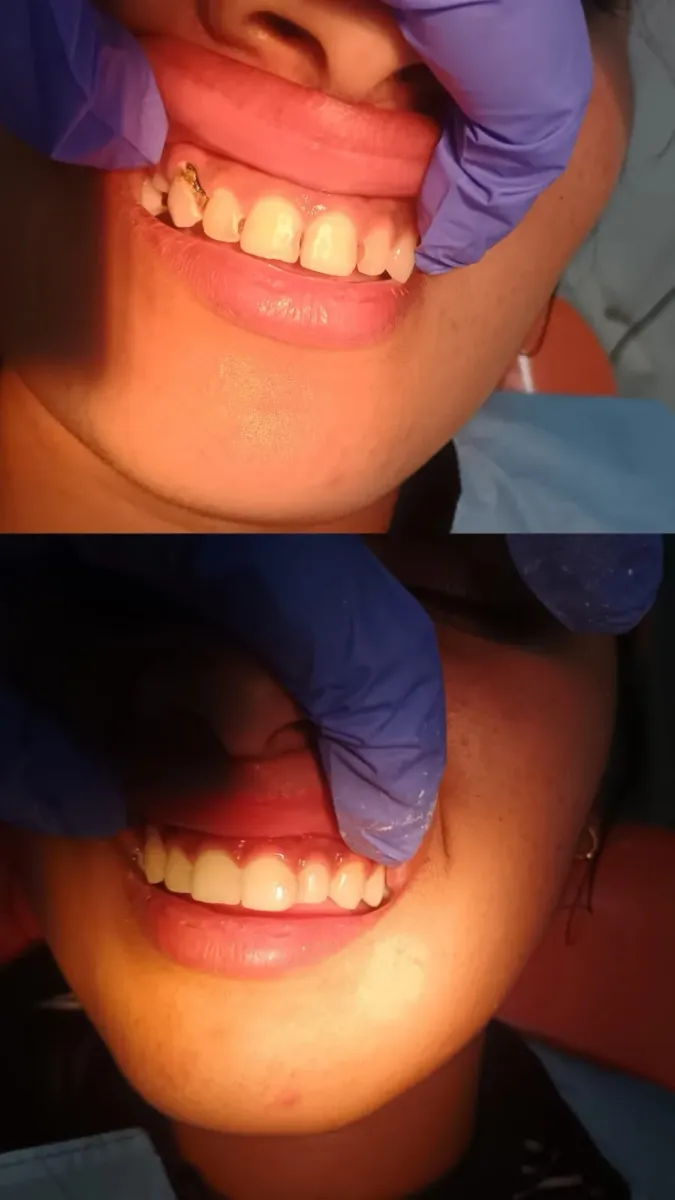 Cosmetic Restoration — before and after