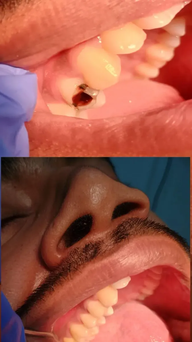 Crown & Bridge — before and after
