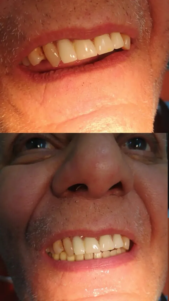 Composite Bonding — before and after