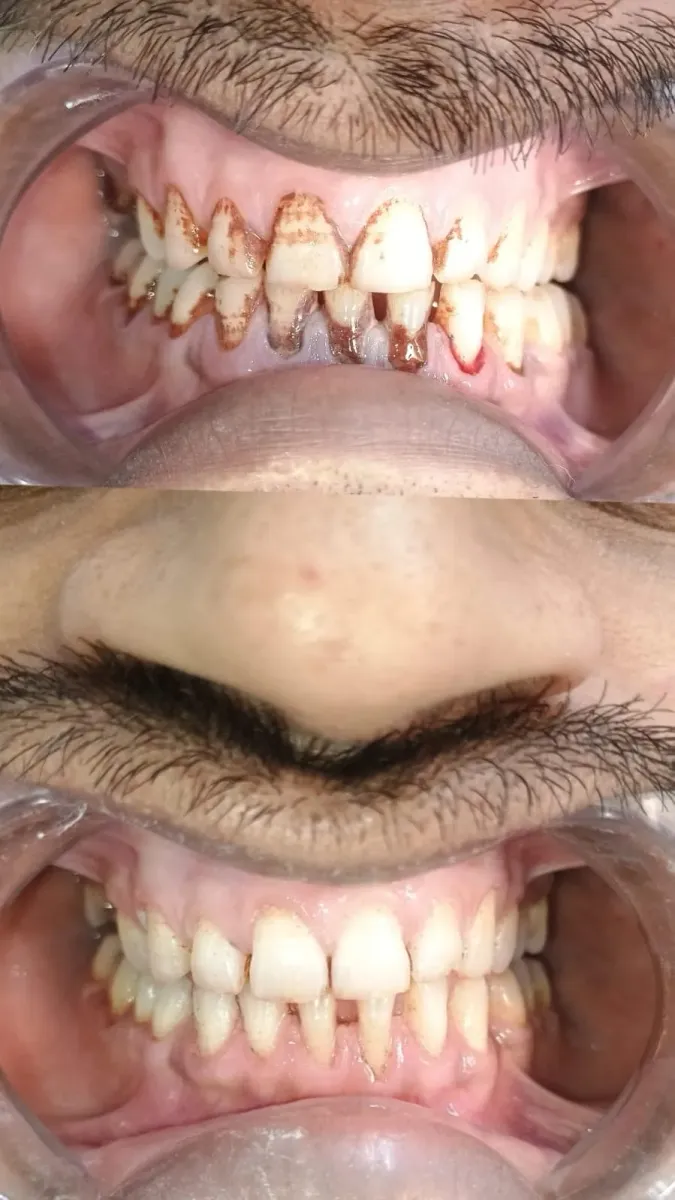 Dental Restoration — before and after