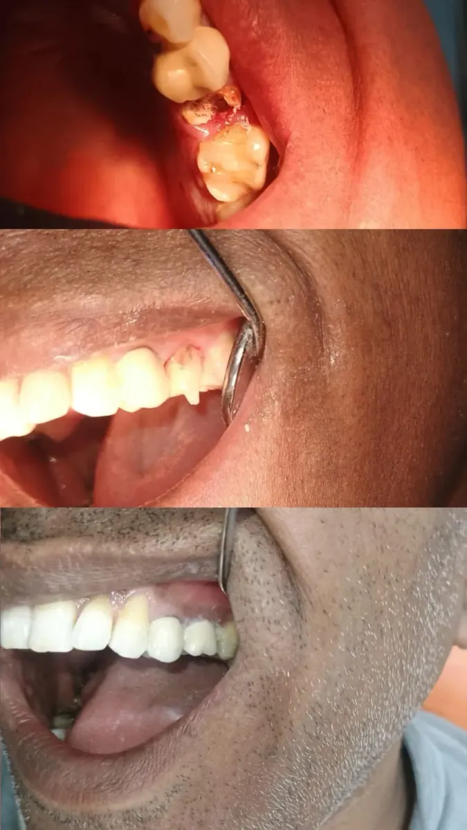 Crown Restoration — before and after