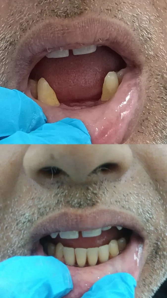 Dental Restoration — before and after