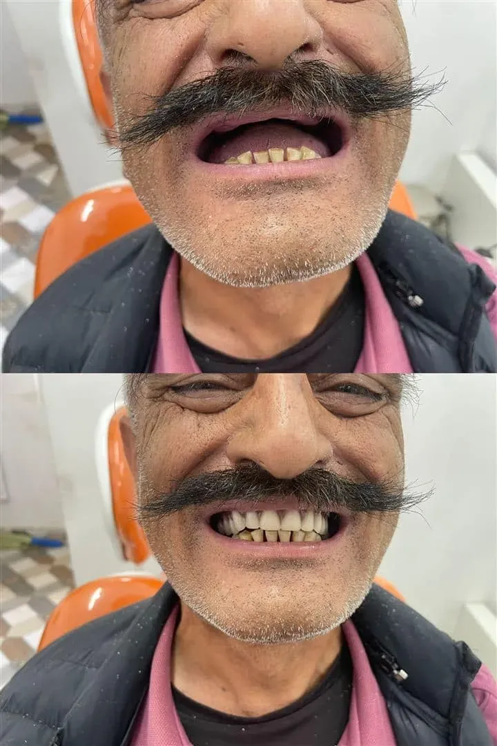 Full Denture — before and after