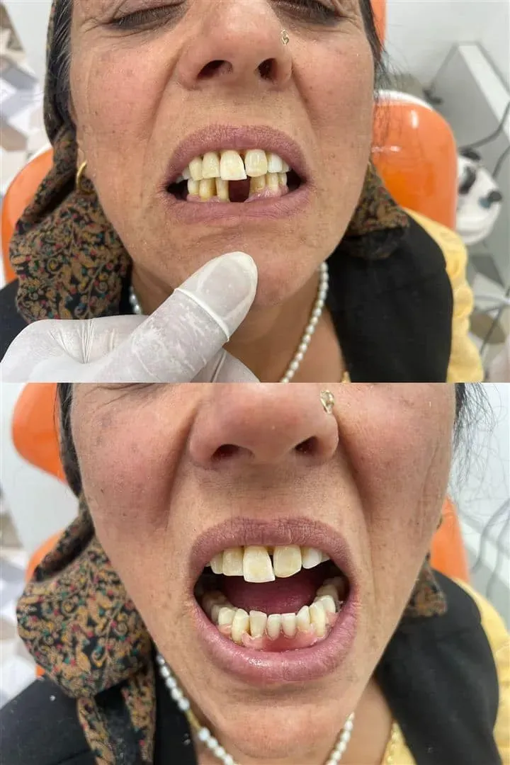Bridge Work — before and after