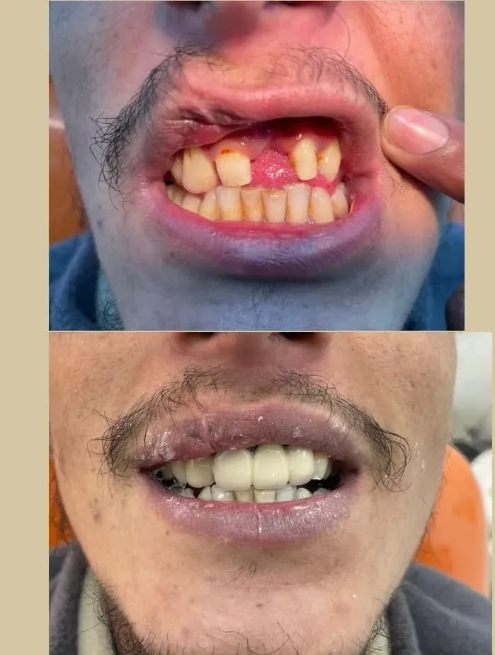 Dental Implant — before and after
