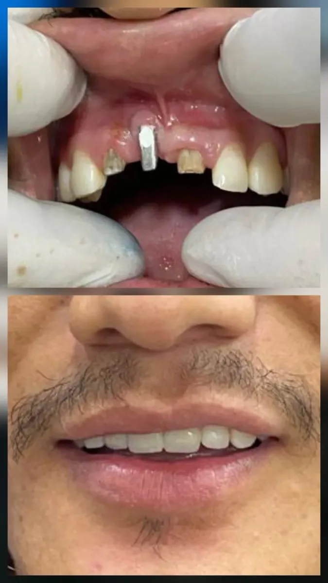 Dental Implant — before and after