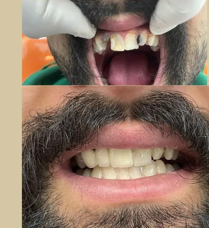 Crown & Bridge — before and after