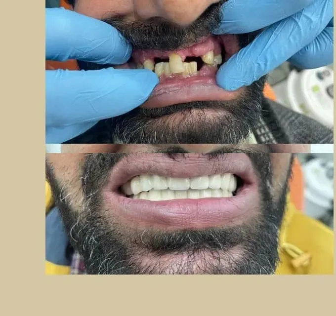 Full Mouth Rehabilitation — before and after