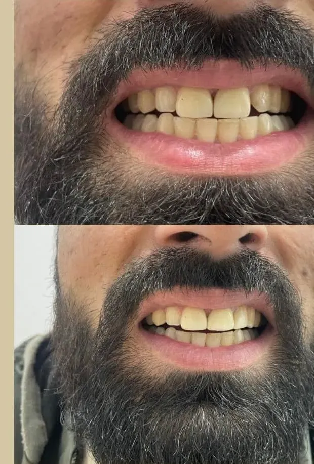 Smile Design — before and after