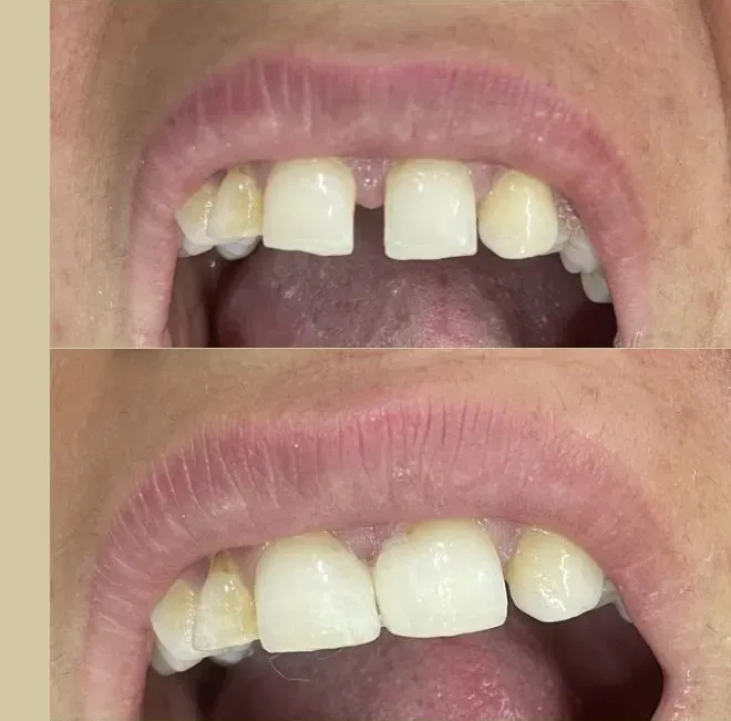 Smile Design — before and after