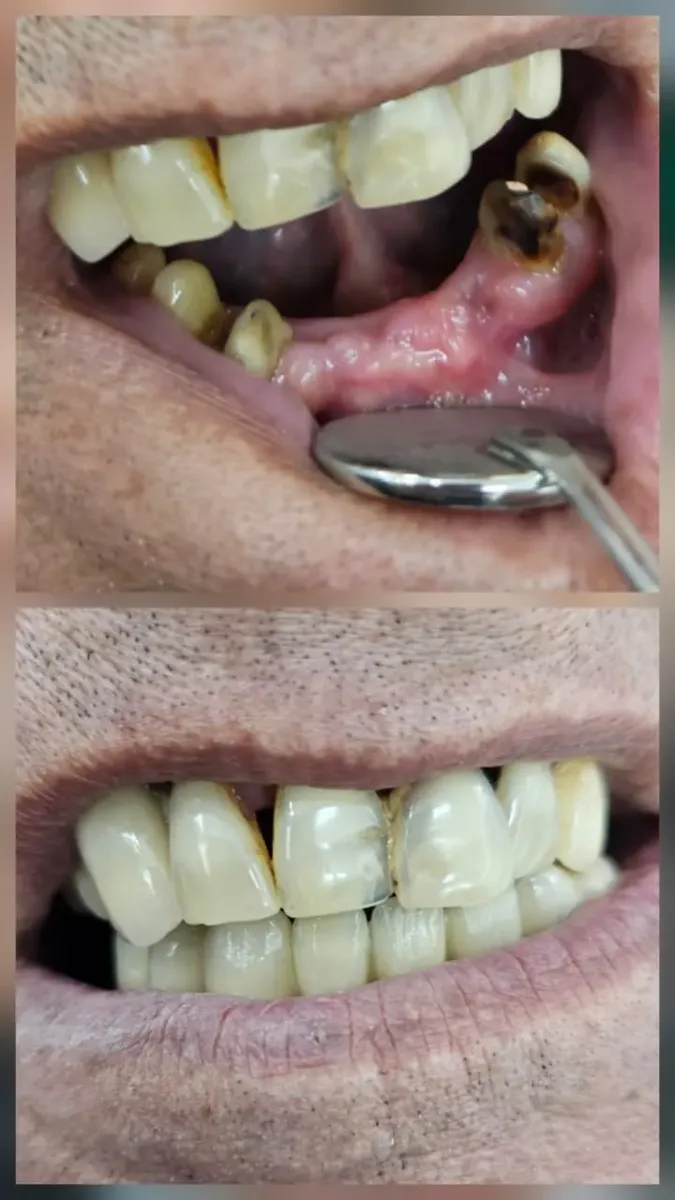 Crown & Bridge — before and after