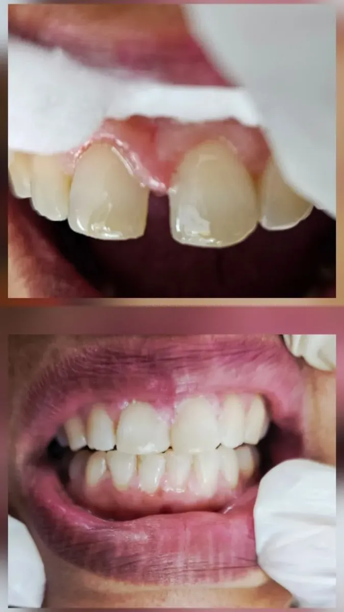 Composite Restoration — before and after
