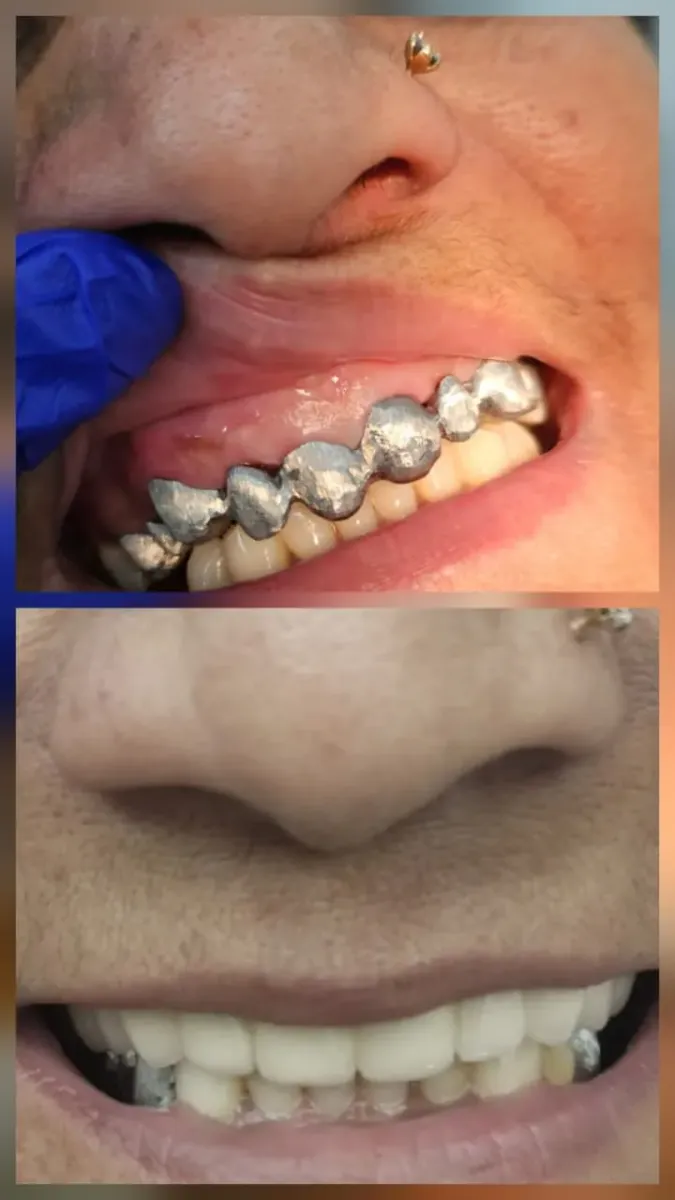 Metal Crown — before and after