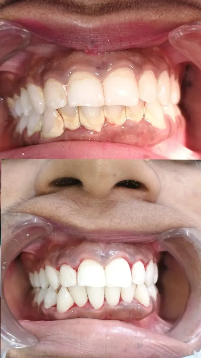 Smile Makeover — before and after