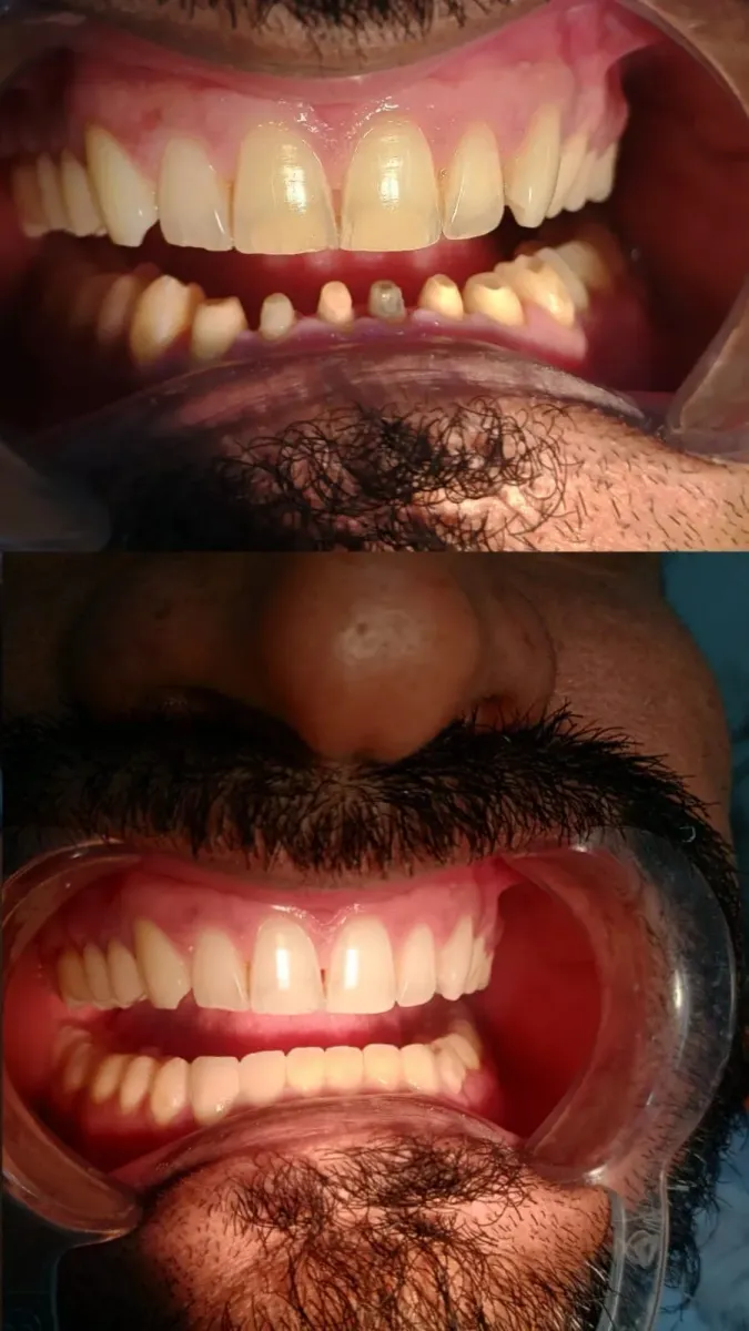 Full Mouth Rehabilitation — before and after